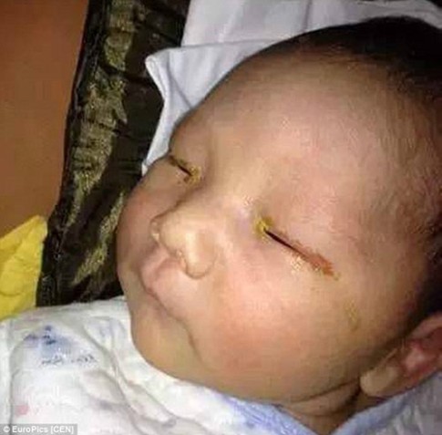 Trung Quốc: Bé 3 tháng tuổi mù mắt vì đèn flash máy ảnh
