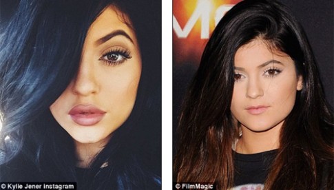 Em gái 17 tuổi của Kim Kardashian thừa nhận bơm môi