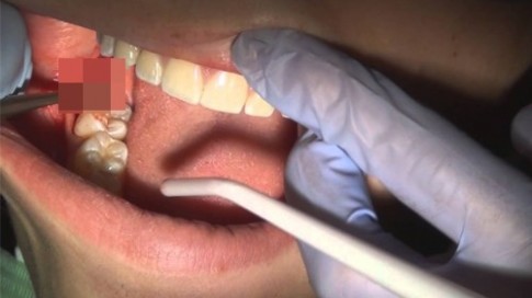 Nhổ răng khôn có gây chết người hay mắc bệnh thần kinh?
