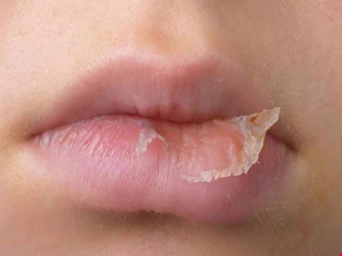 3 thành phần dễ gây dị ứng trong son môi