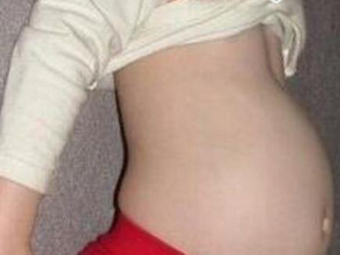 Bào thai ngày một lớn trong bụng bé gái 4 tuổi khiến cha mẹ “chết lặng”