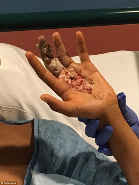 Cậu bé 13 tuổi suýt mất tay chỉ vì vết cứa do mũ bảo hiểm