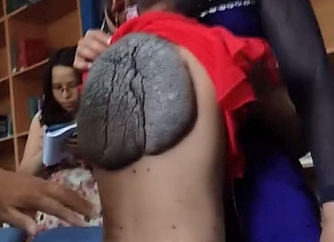 Chữa trị thành công cho bé gái 10 năm mang “mai rùa” hơn 1kg trên lưng