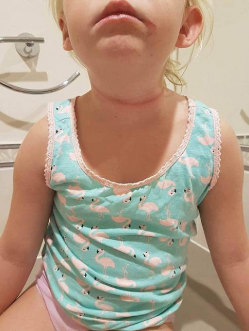 Chỉ vì chiếc dây quai mũ, bé gái 6 tuổi bị siết cổ gần nghẹt thở