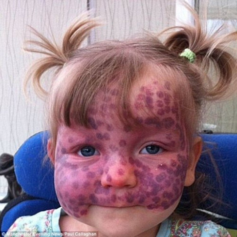 Khuôn mặt khác lạ sau phẫu thuật của bé gái bị chàm trên mặt